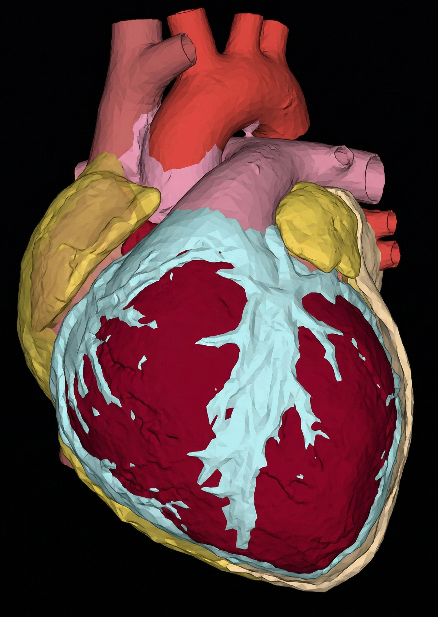 3D segmented heart reconstruction showing epicardial and paracardial fat tissue